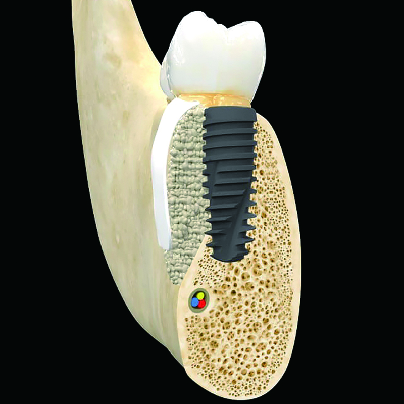 뼈이식 임플란트