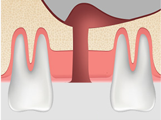 치조정접근법 순서2