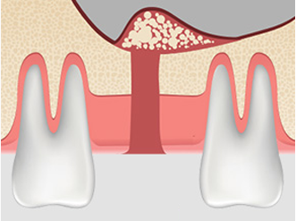 치조정접근법 순서3