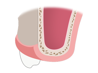 외측 접근법 순서1