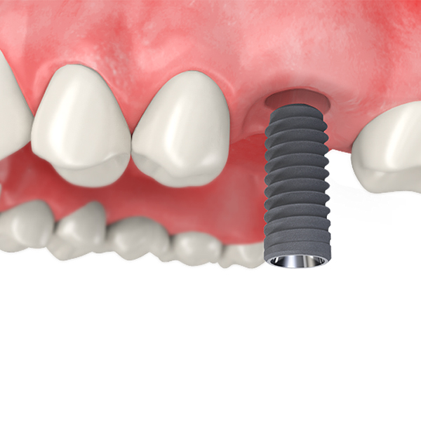 원데이 임플란트